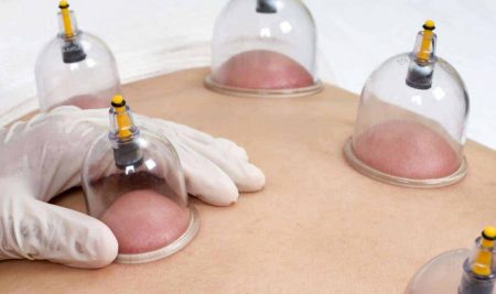 Hijama Cupping Certification Course – UK